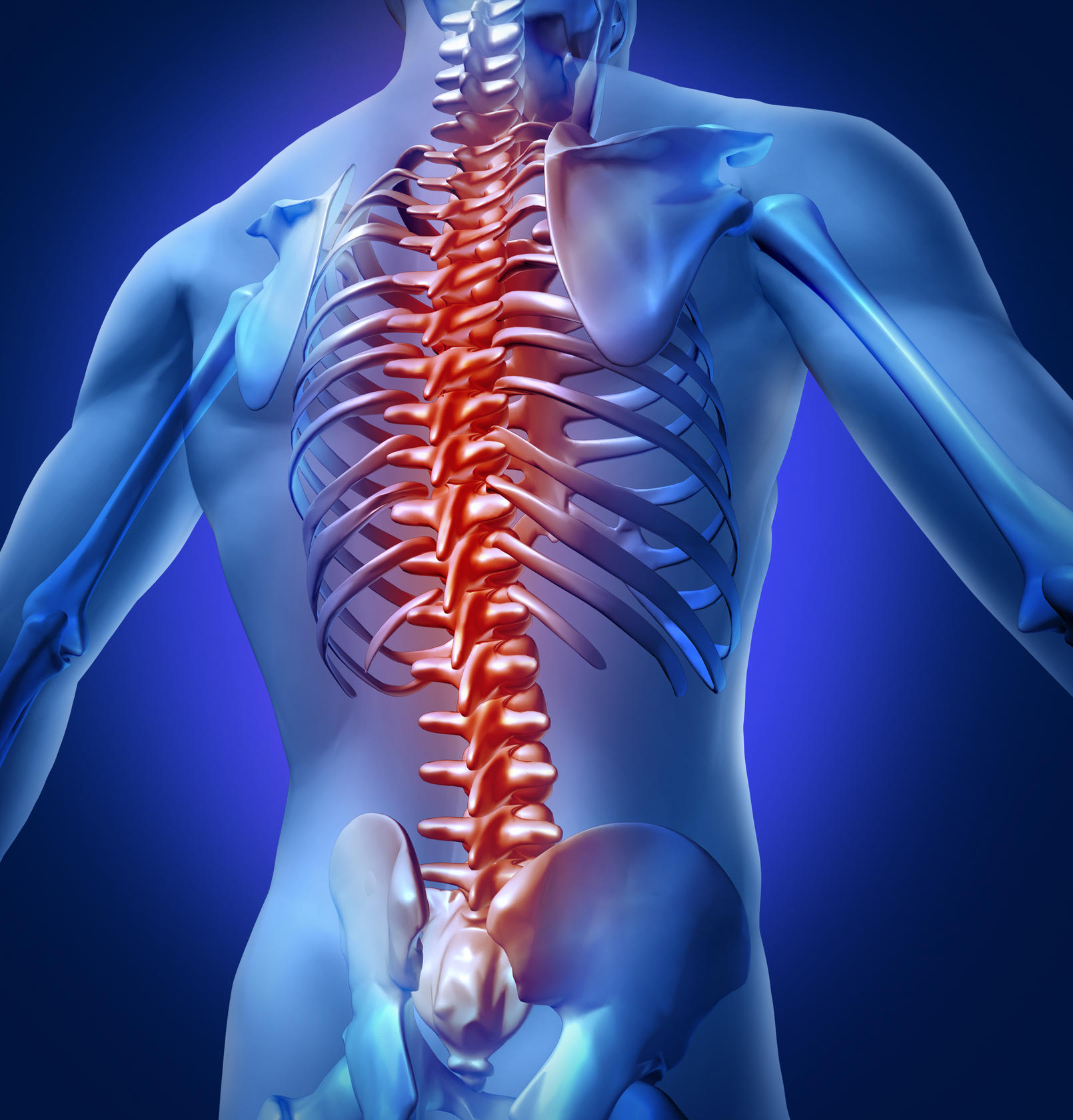 Illustration of a spinal cord injury. 