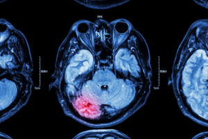 Can Physical Violence Cause Traumatic Brain Injury?